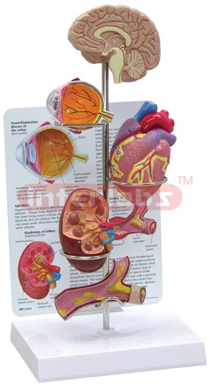 Hypertension Model Set